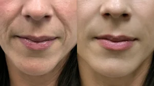 Bigode Chinês Como Tratar: Descubra o Ritual Anti-Flacidez que Está Chamando Atenção