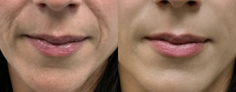Bigode Chinês Como Tratar: Descubra o Ritual Anti-Flacidez que Está Chamando Atenção