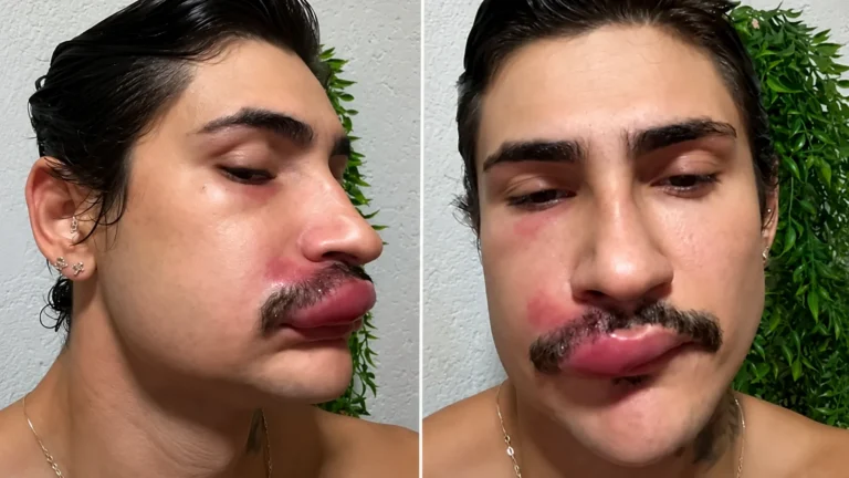 Ken de CG mostra rosto inchado após infecção por causa de espinha e faz alerta aos seguidores