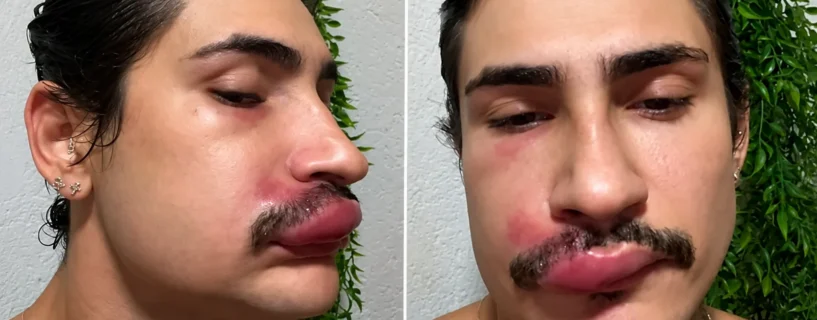 Ken de CG mostra rosto inchado após infecção por causa de espinha e faz alerta aos seguidores